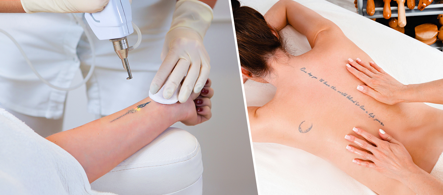 Détatouage au Laser