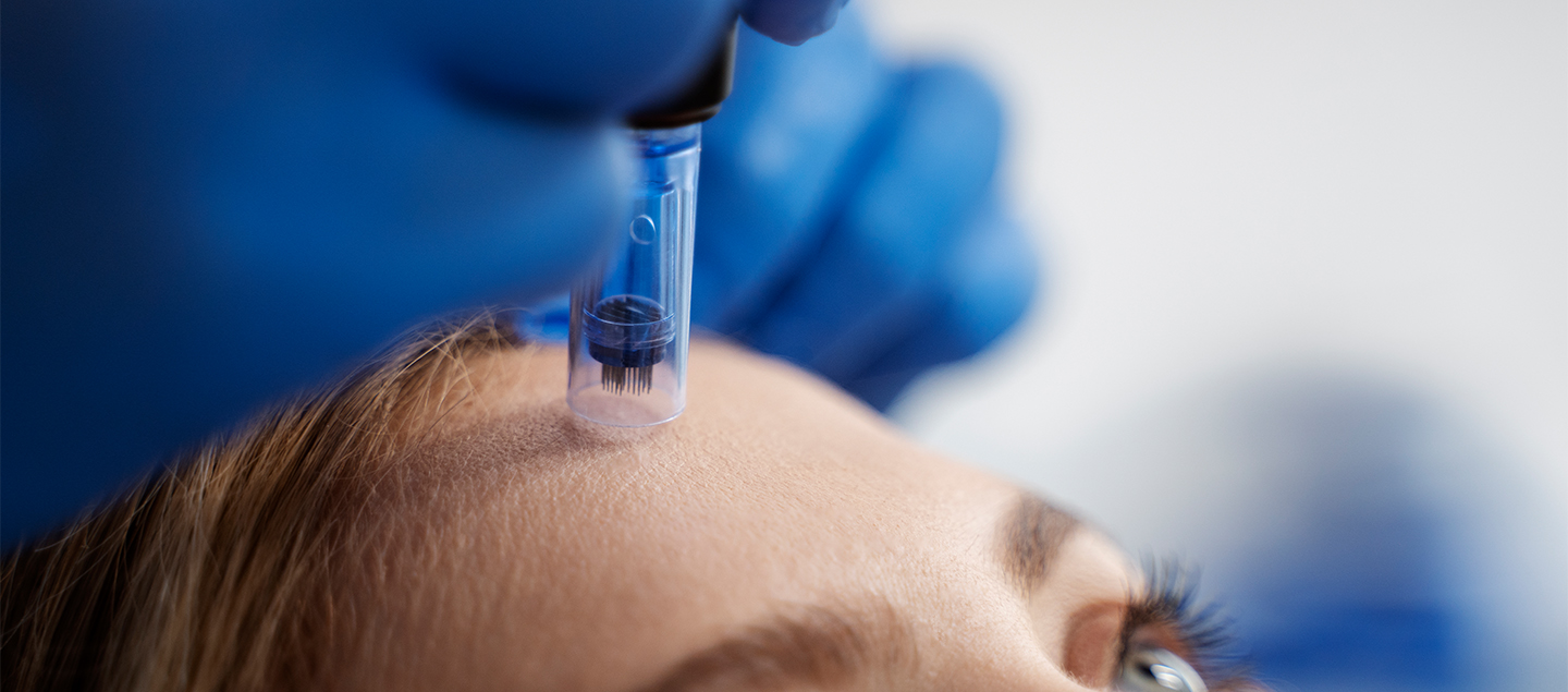 Soin du visage et cou Microneedling - 1, 3 ou 6 séances