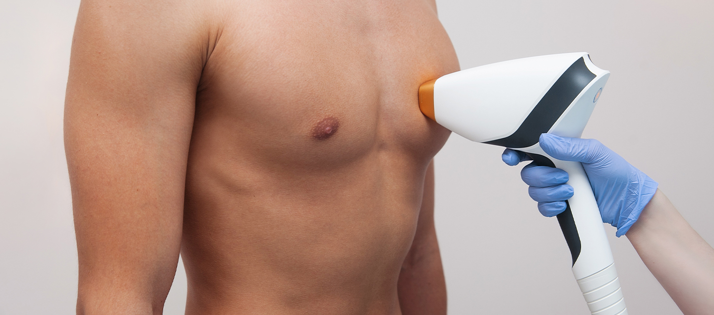 Epilation au laser diode pour Homme - 3 ou 6 séances