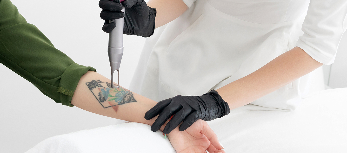 Détatouage Laser Pico sur zone au choix