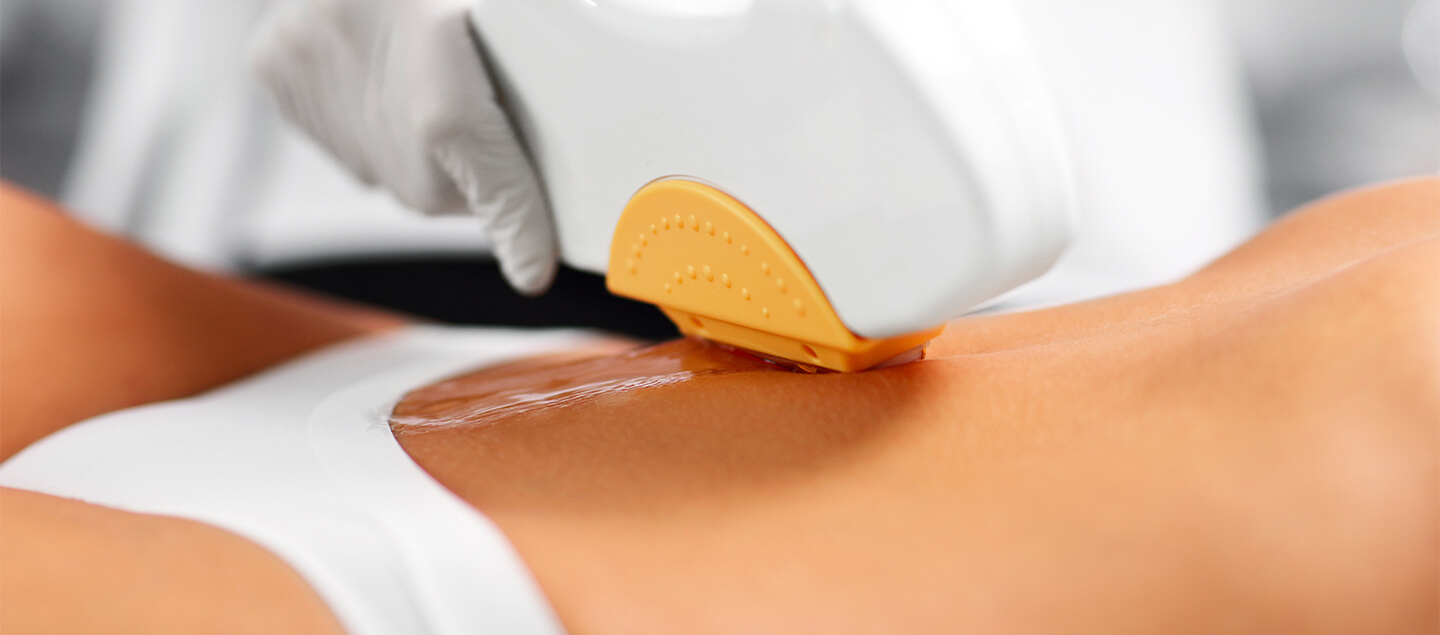 Epilation définitive au laser diodes sur zone au choix