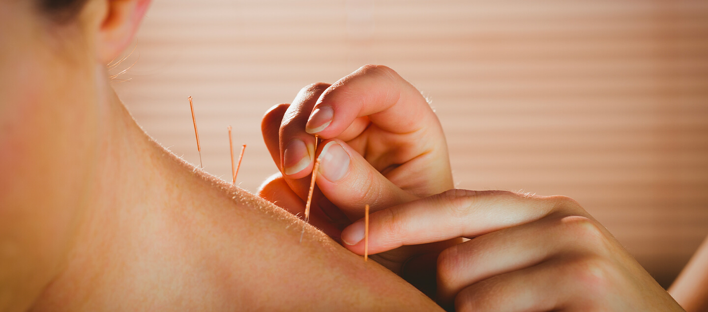 Perte de poids par l'acupuncture