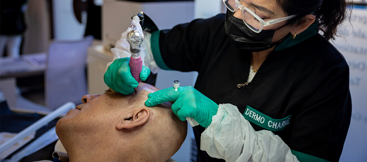 Micro-pigmentation du cuir chevelu pour pallier à la perte de cheveux - sur zone au choix