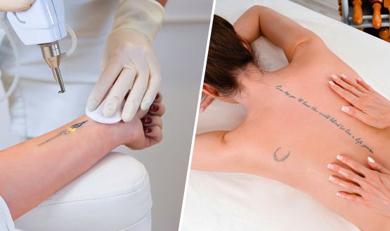 Détatouage au Laser