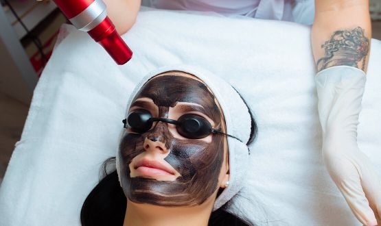 Peeling doux du visage par Carbon Laser
