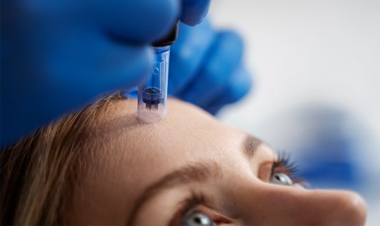 Soin du visage et cou Microneedling - 1, 3 ou 6 séances