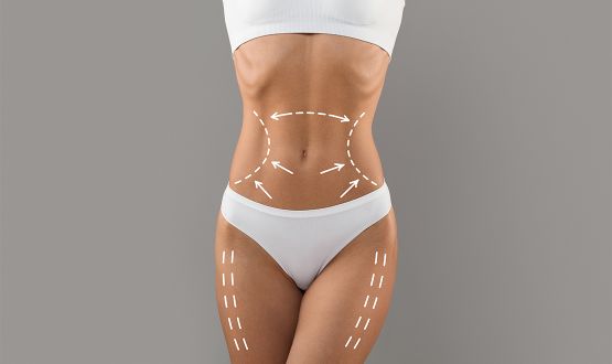 Bodycontouring par HIFEM - 1 ou 3 séances