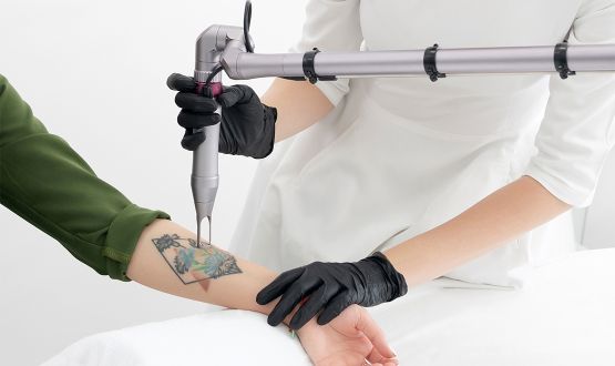 Détatouage Laser Pico sur zone au choix