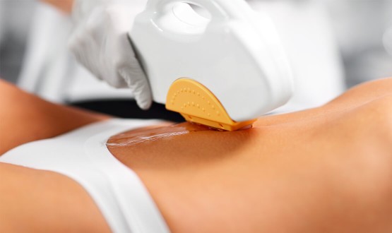 Epilation définitive au laser diodes sur zone au choix