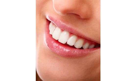 1 séance de Blanchiment dentaire